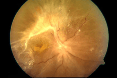 La retinopatía diabética puede cursar con desprendimiento de retina por tracción.