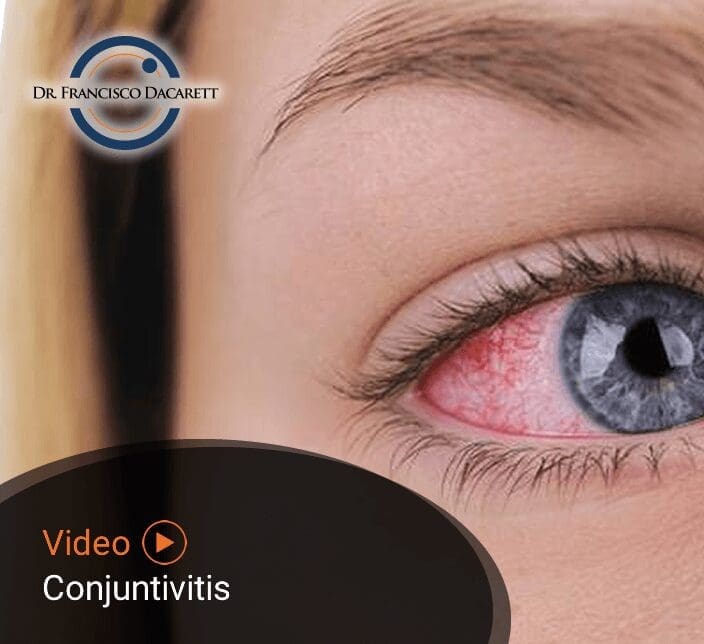 Conoce más sobre la Conjuntivitis por el oftalmólogo y retinólogo Dr. Francisco Dacarett