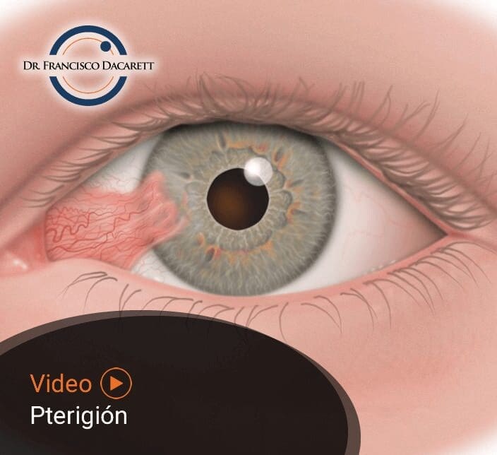 Conoce más sobre el Pterigión por el oftalmólogo y retinólogo Dr. Francisco Dacarett