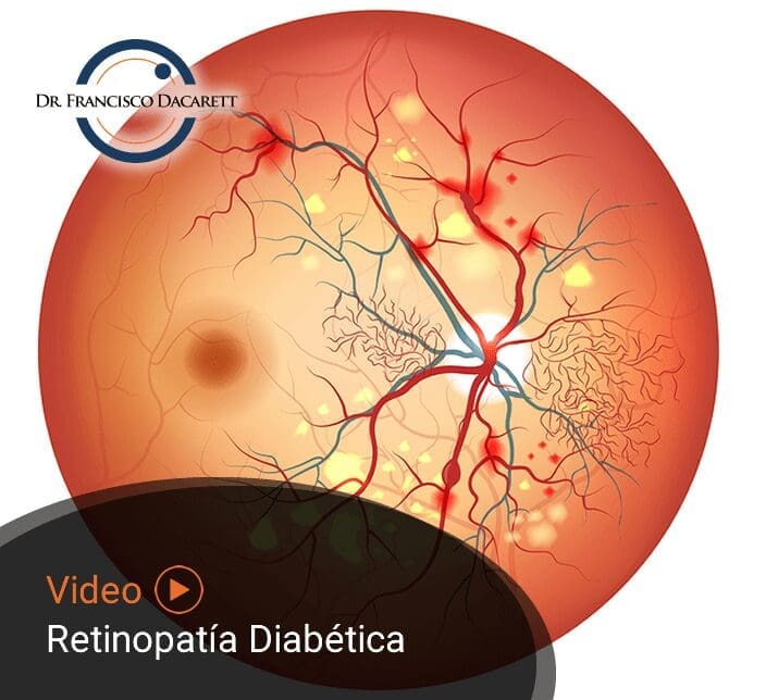 Conoce más sobre la Retinopatía Diabética por el oftalmólogo y retinólogo Dr. Francisco Dacarett